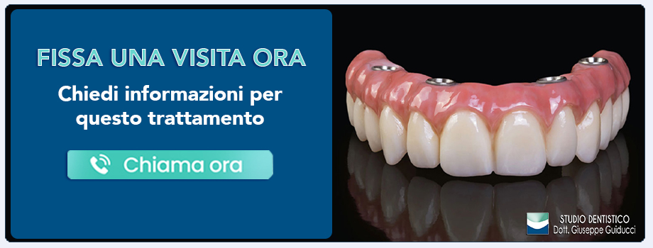implantologia-all-on-four-impianti-dentali-all-on-four Pescara