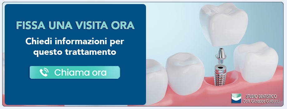 implantologia-singolo-dente Pescara